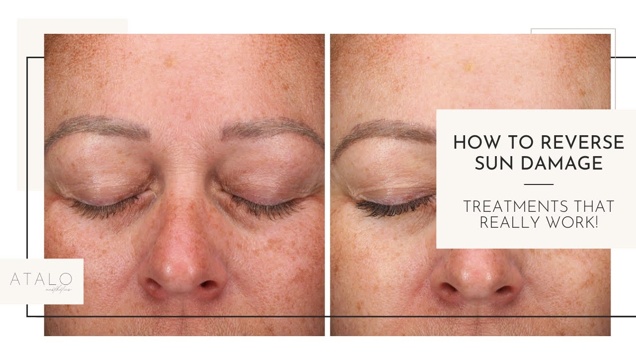 How To Reverse Sun Damage