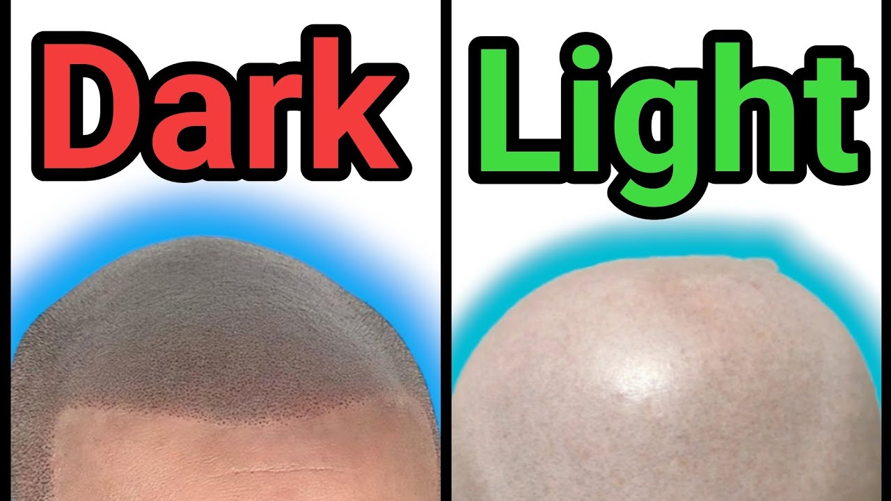 Why Dark SMP will become botched SMP | Scalp Micropigmentation