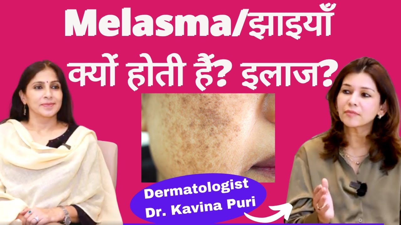 Melasma/Hyperpigmentation/चेहरे पर झाइयाँ क्यों हो जाती हैं, क्या है इलाज, घर पर क्या कर सकते हैं?