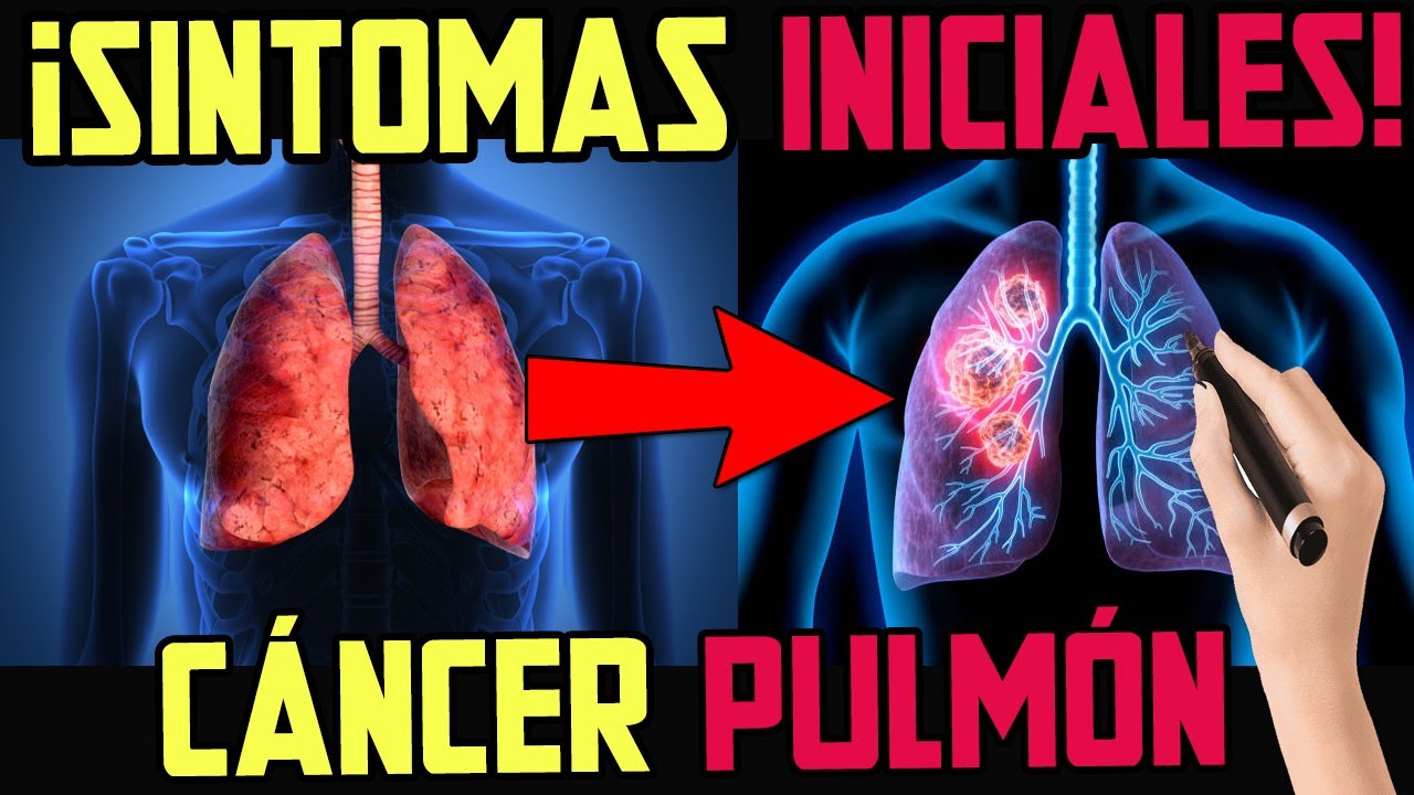 PELIGRO! 8 SINTOMAS DEL CÁNCER DE PULMÓN