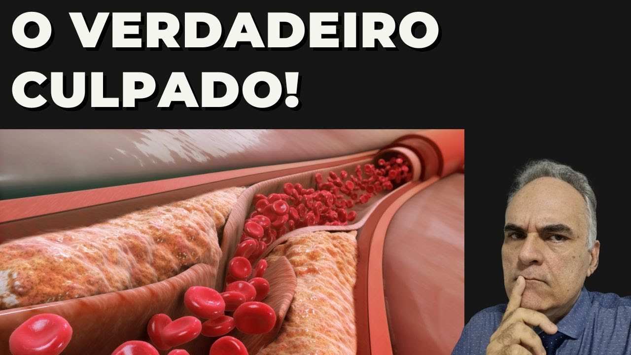 Os 2 alimentos que mais entopem as artérias e causam infarto!