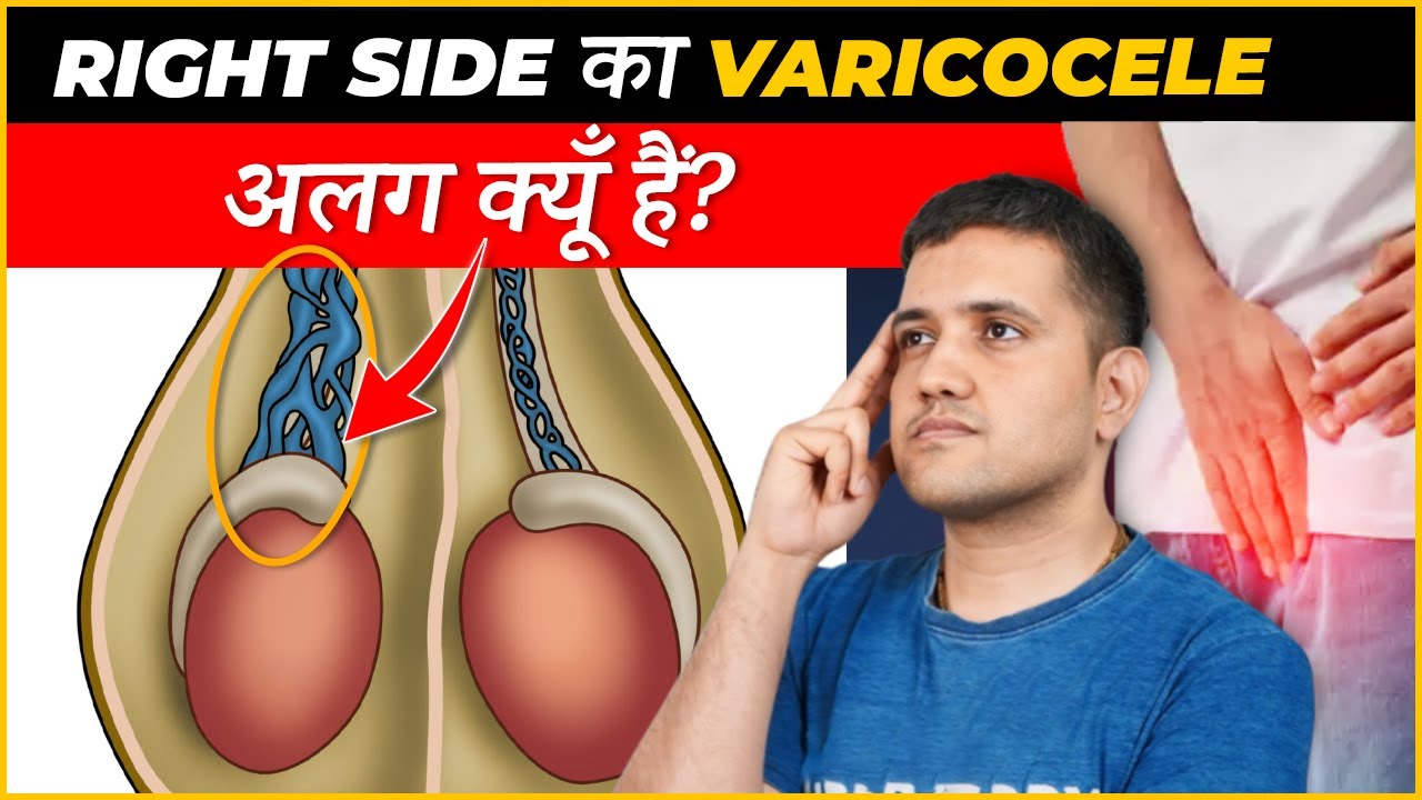 Why Right Varicocele Is Different and Uncommon ? | Dr. Gaurav Gangwani (Interventional Radiologist)