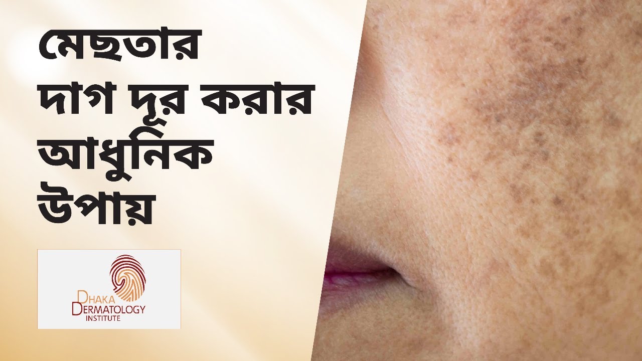 মেছতার দাগ দূর করার আধুনিক উপায়