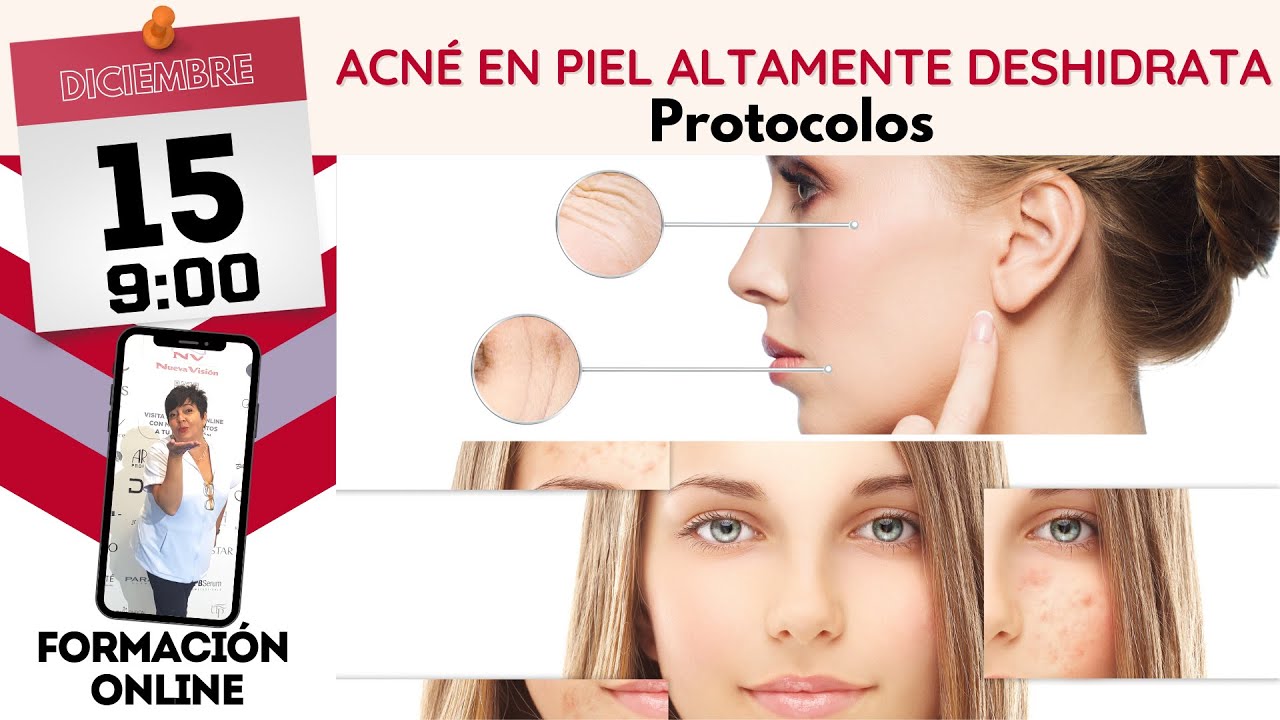 ¿Cómo trato el acné en una piel deshidratada?