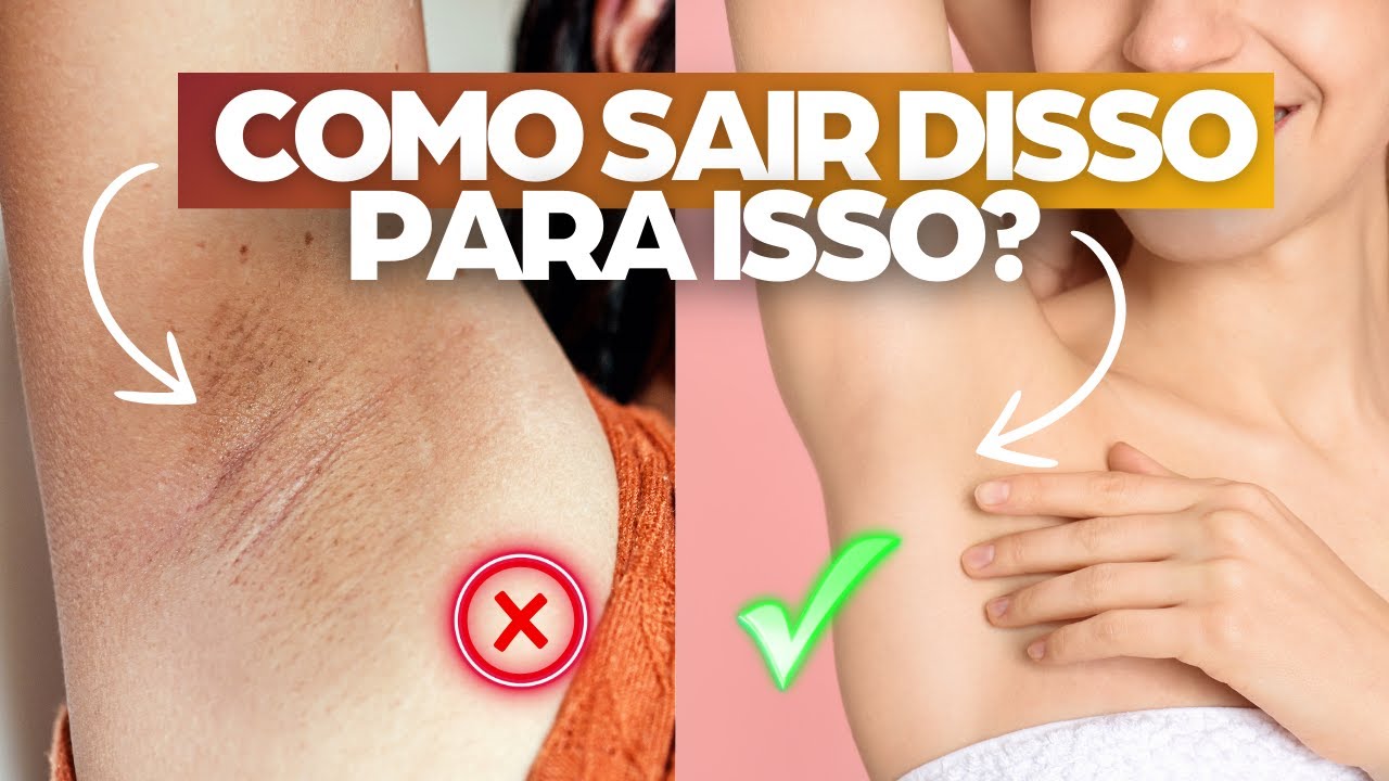 Como NÃO TER MANCHAS NAS AXILAS com a Esteticista