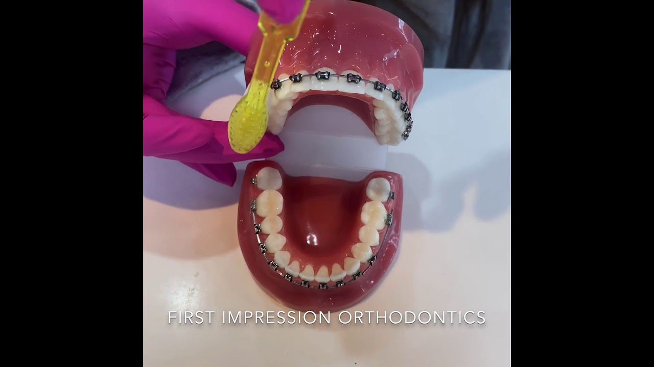 Hygiene - brushing & flossing with braces