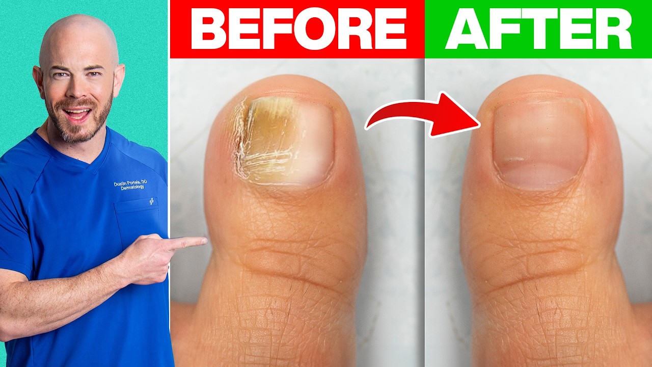 How to Treat Toenail Fungus - Derm Recommends