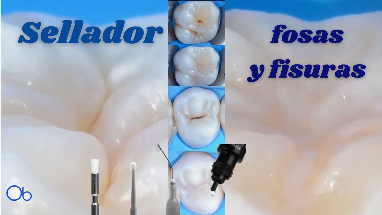 Colocación de Sellador de fosas y fisuras 🦷 paso a paso