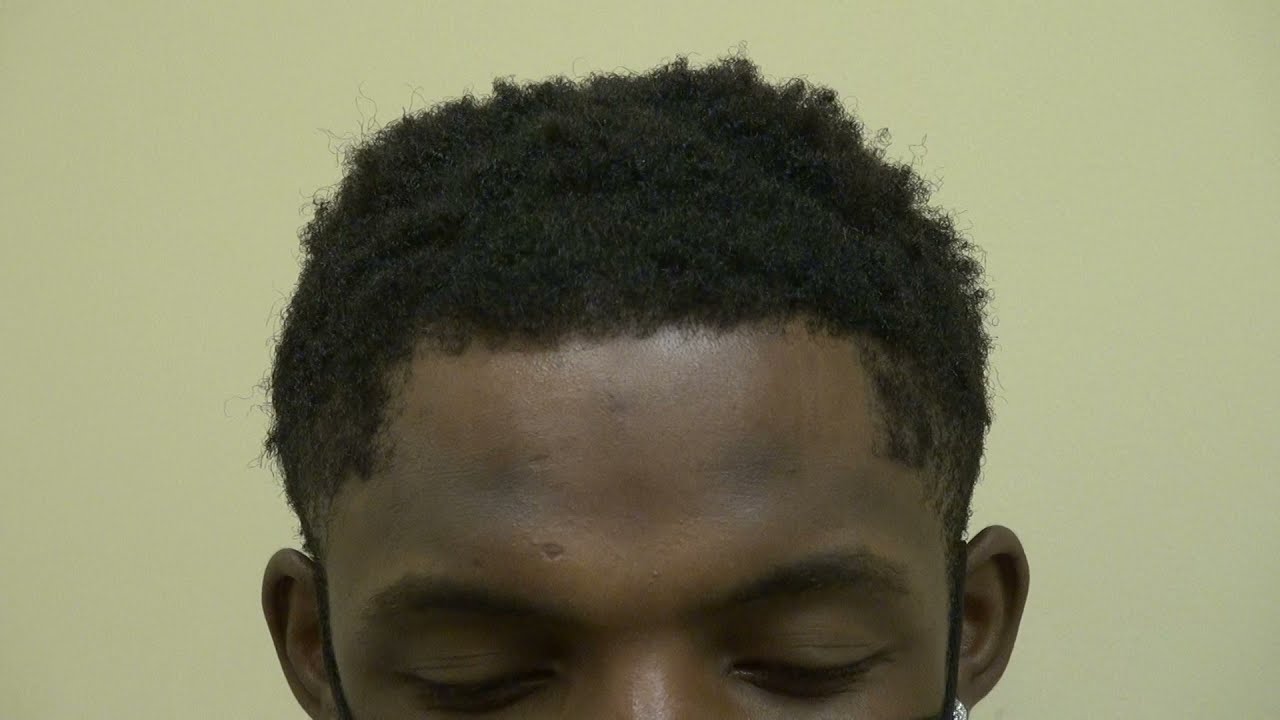 Hair Transplant on African American Curly Hair by Dr. John Diep