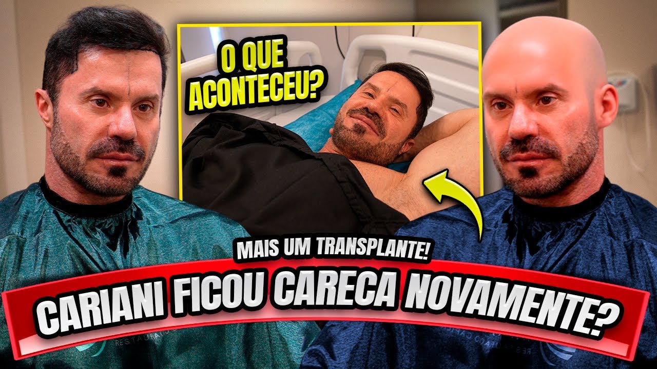CARIANI FICOU CARECA NOVAMENTE? MAIS UM TRANSPLANTE CAPILAR