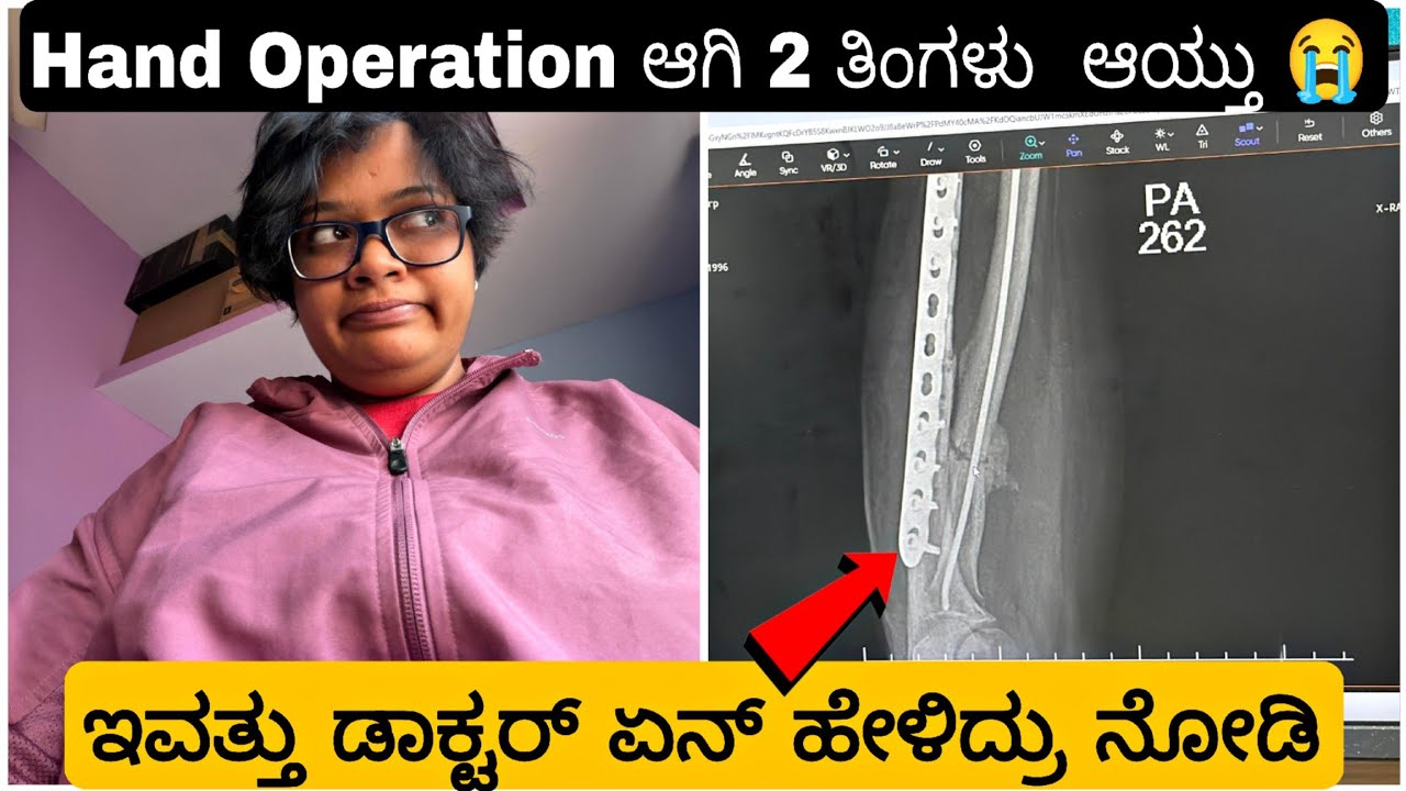 ನನ್ನ Hand Surgery ಆಗಿ 2 ತಿಂಗಳು ಆಯ್ತು..ಈವತು Xray ಮಾಡಿಸಿ ಡಾಕ್ಟರ್ ಏನ್ ಹೇಳಿದ್ರು ನೋಡಿ..😭