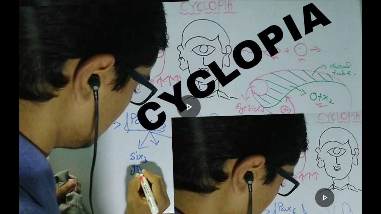 CYCLOPIA#BABY WITH ONE EYE BY-SWAGATAM DAS