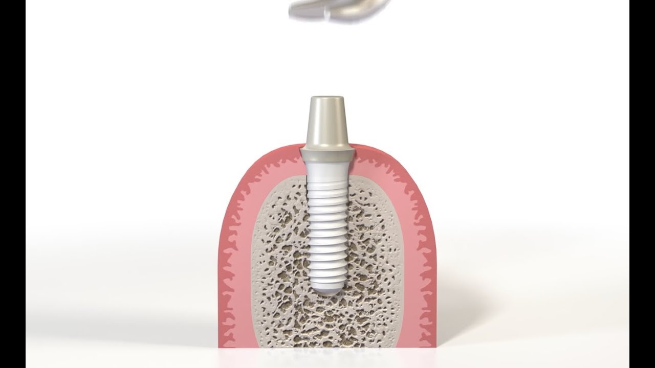 Implante Cerâmico - Pure Ceramic Straumann 【ツ】 Dentista Sorridere