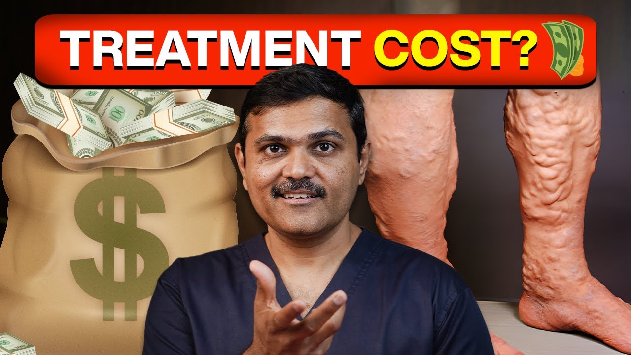 WARNING Varicose Vein Mistakes That Could Drain Your Bank Account!