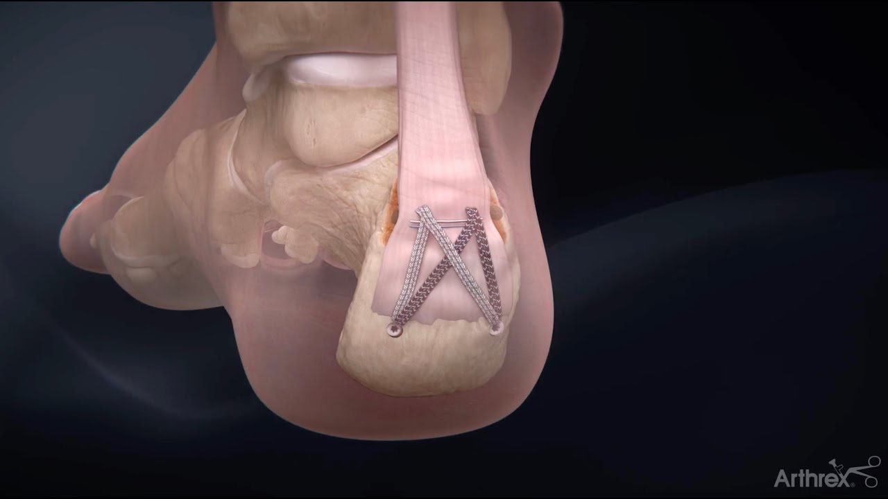 Система MIS Achilles SpeedBridge&trade;