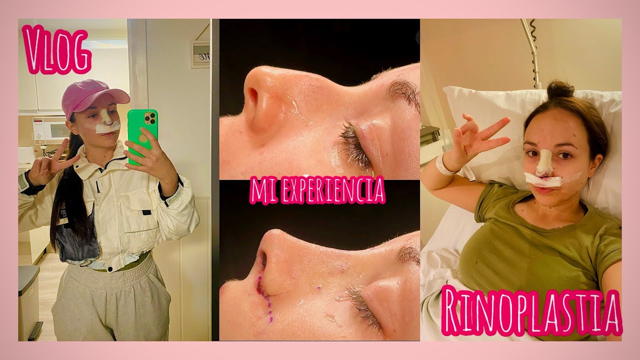 Mi EXPERIENCIA haciéndome una RINOPLASTIA👃🏼💖 