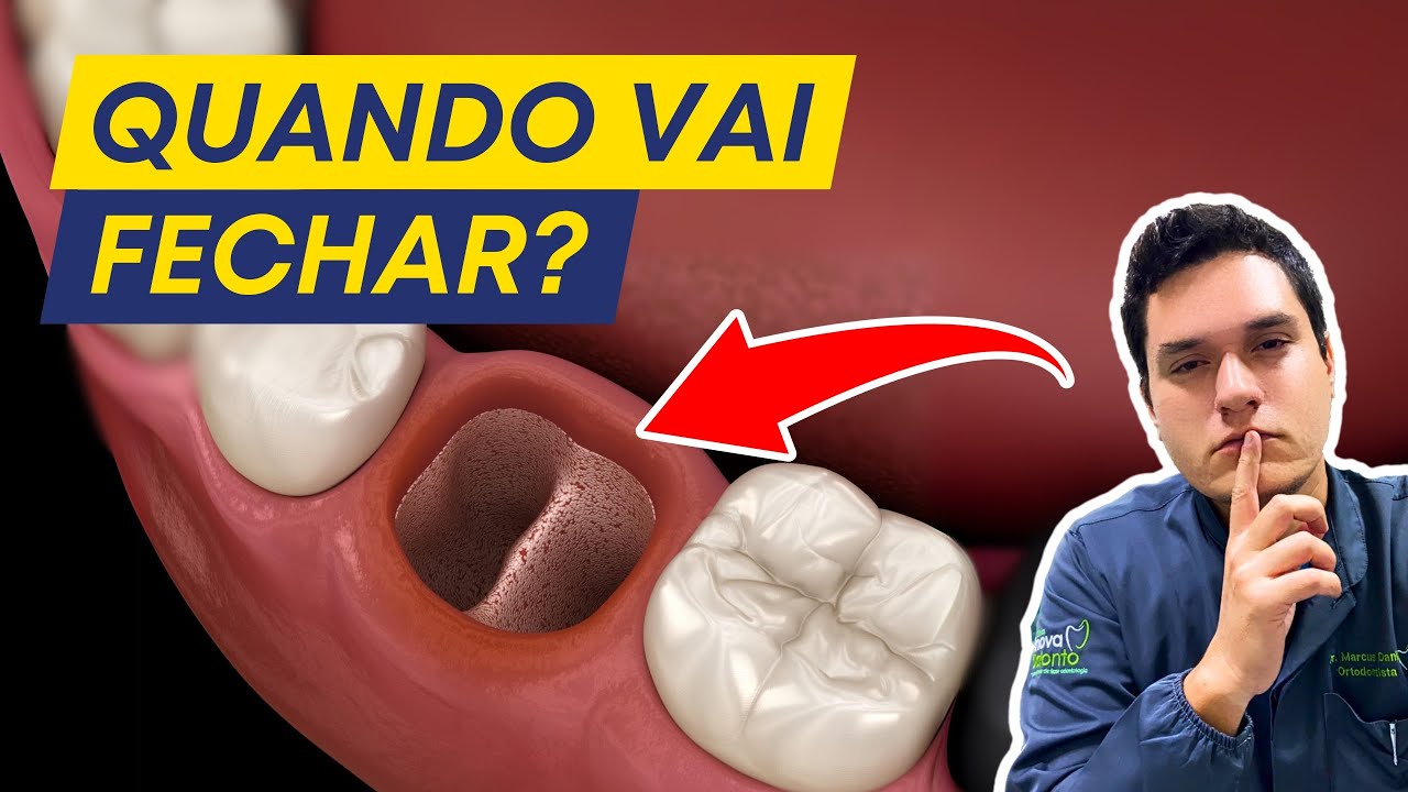 QUANTO TEMPO DEMORA PARA O BURACO DO SISO FECHAR APÓS SER EXTRAÍDO?