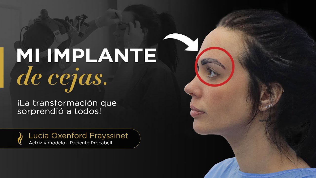 Lucía Oxenford Frayssinet confió en Procabell Cirugía Avanzada para realizarse su implante de cejas!