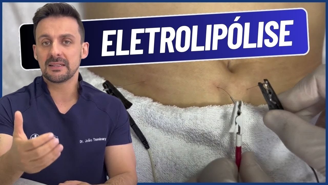 COMO APLICAR ELETROLIPÓLISE | DR. JOÃO TASSINARY