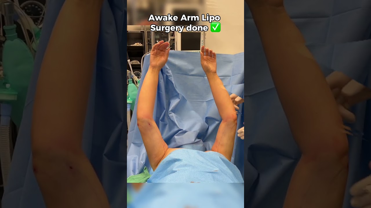 Arm liposuction only (no arm lift)  2 weeks result!  #liposuction #beforeandafter #armliposuction
