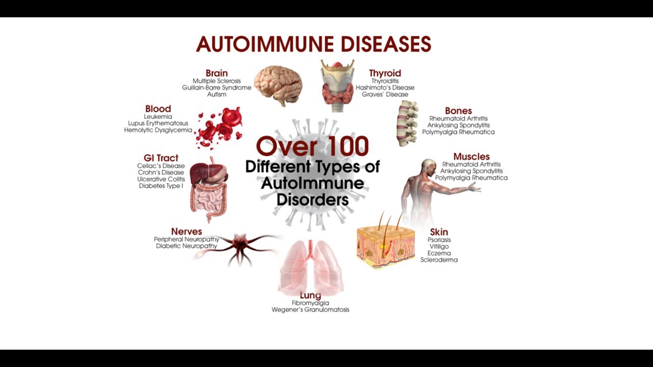 Environmental Triggers in the Development of Autoimmune Diseases