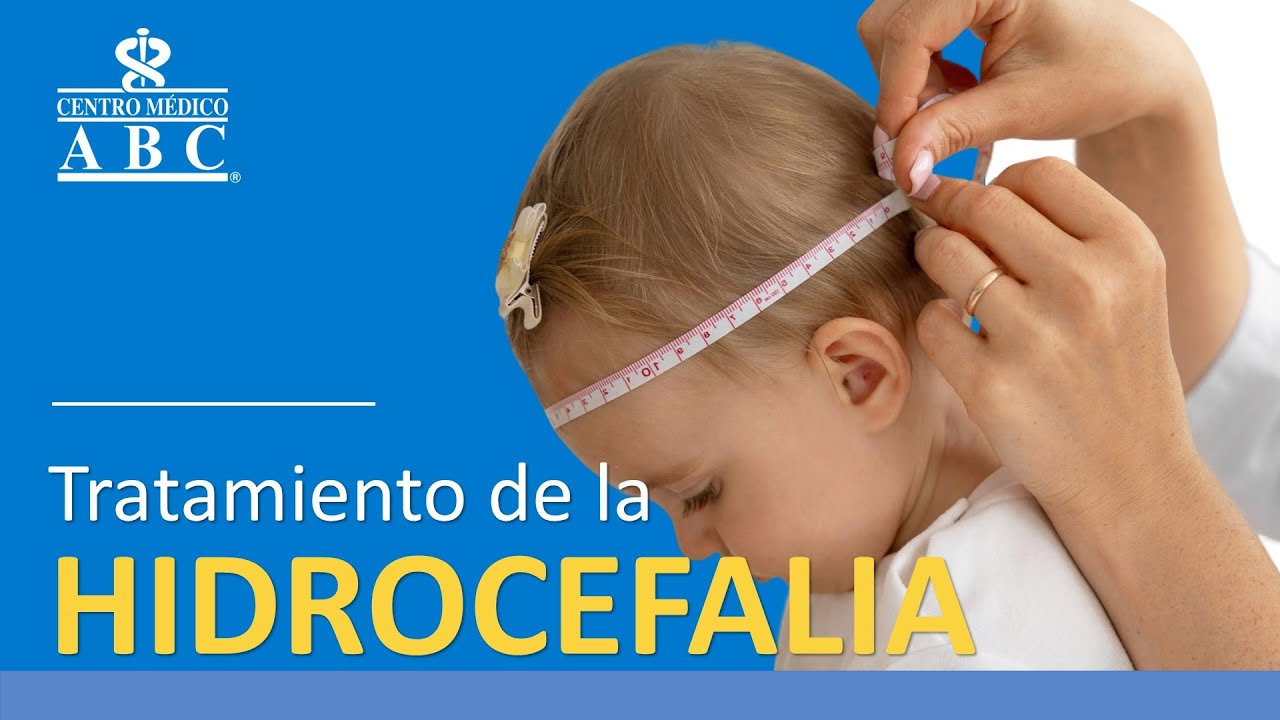 Tratamientos de la hidrocefalia