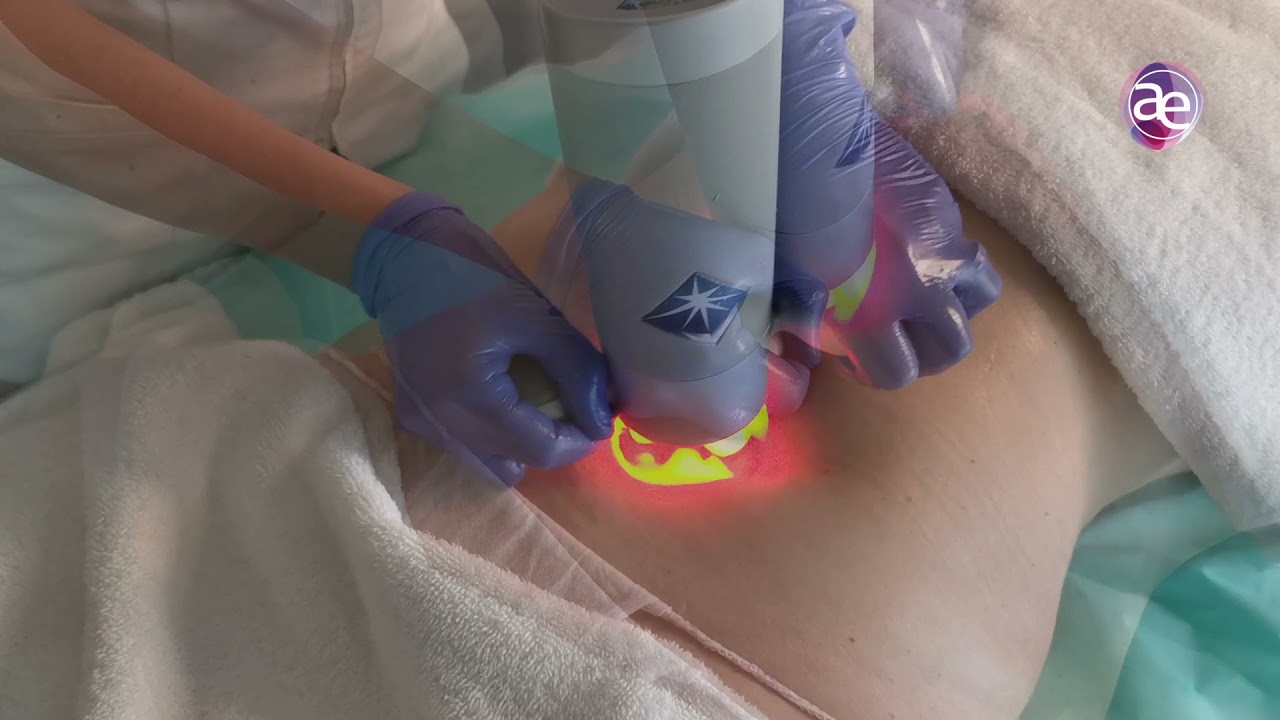 BELLACTION DUO - VALENCIA - Remodelación corporal, celulitis y volúmen