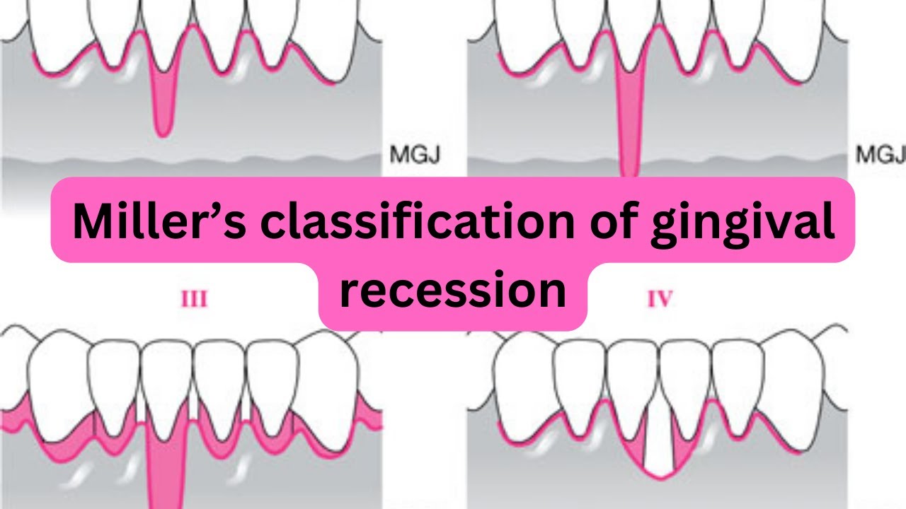Какова классификация рецессии десны по Миллеру?
