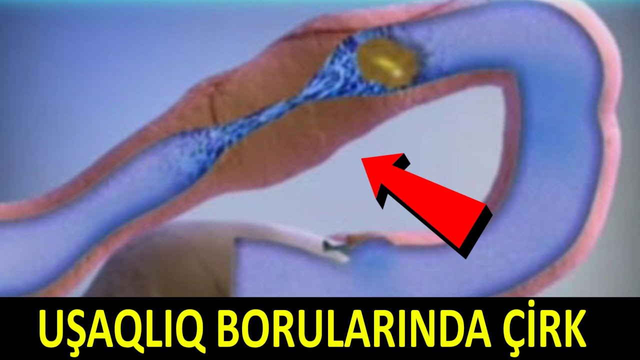 Uşaqlıq borularında çirk - Qadınlar Baxsın