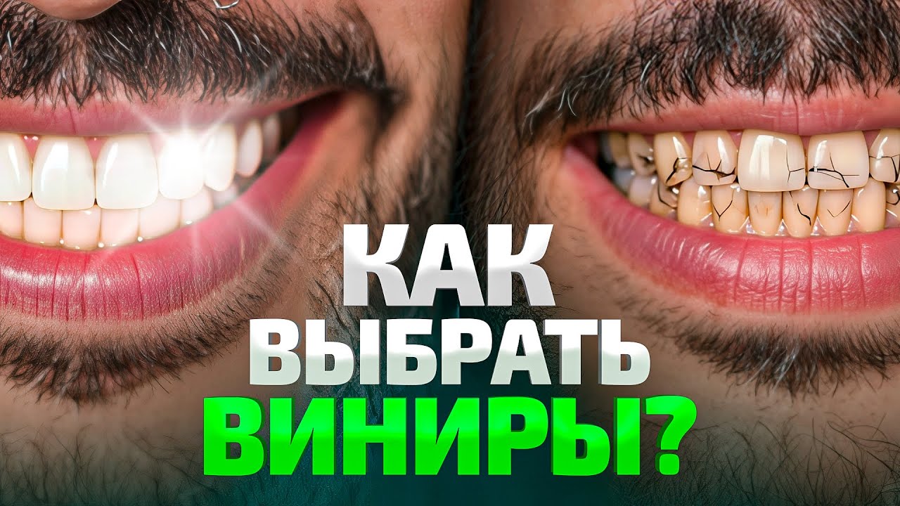 Как на самом деле ставят ВИНИРЫ в 2026? Весь процесс от А до Я