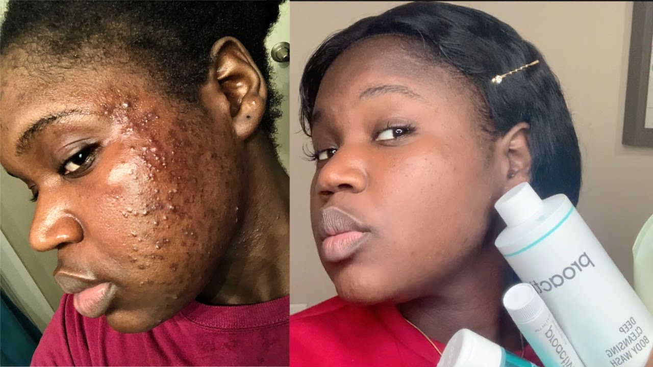 (UPDATE)Proactive Acne Solutions Saved My LIFE (AFTER ONE YEAR)