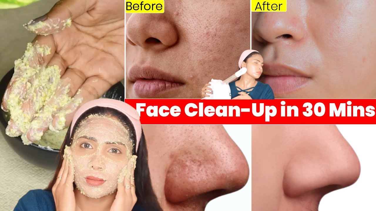 ऐसे करे Skin Clean-Up 30 Mins में सारी गंद Blackheads Whiteheads बहार- चेहरा Clean Smooth और Glowing