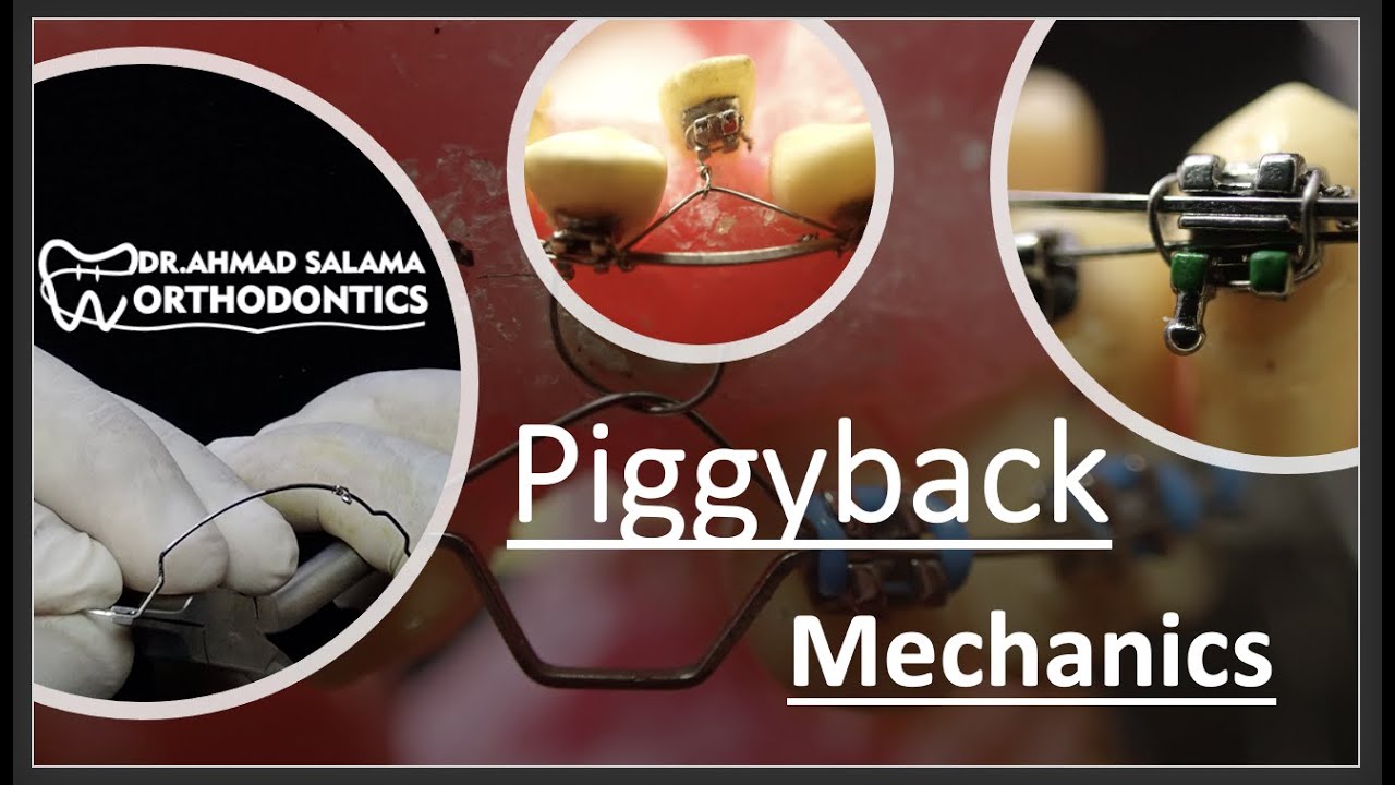 ep17. Piggyback Mechanics | Ortho A.W.(workshop - p2)  (double wire technique)