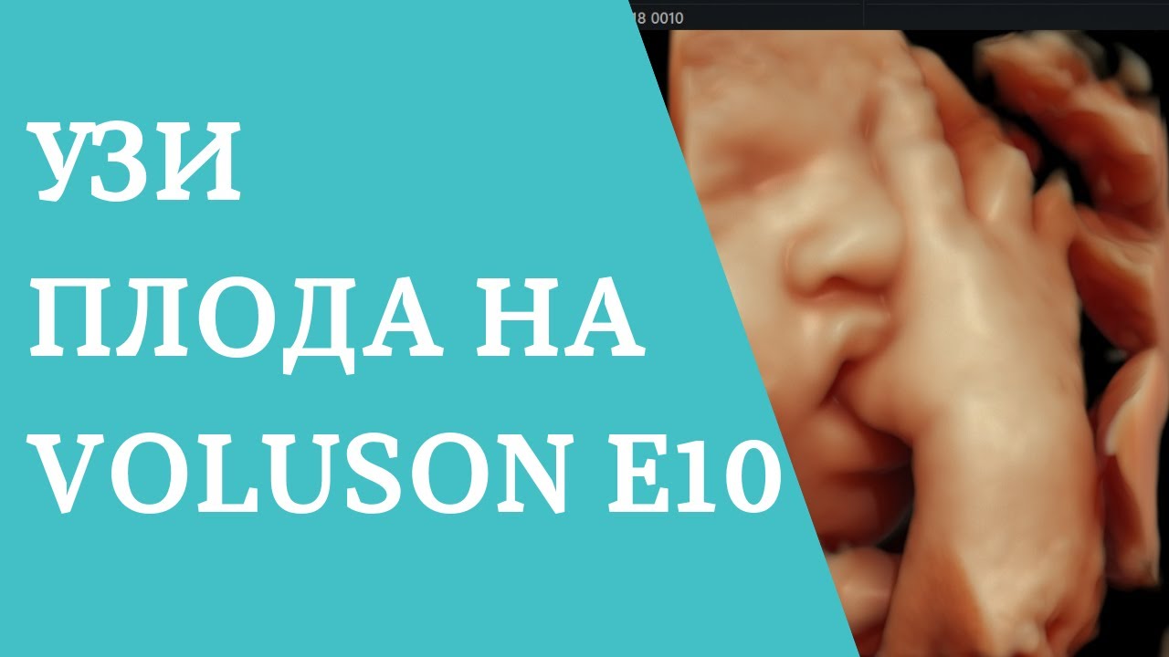 УЗИ (ультразвуковое исследование) плода на Voluson E10