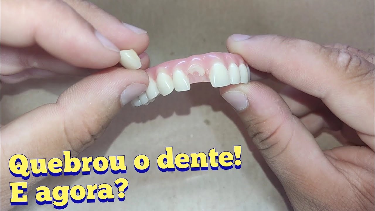 Consertando dente da pr&oacute;tese parafusada