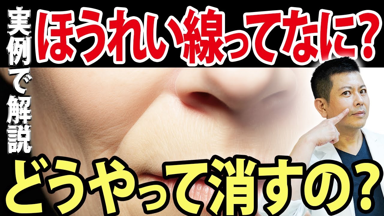 【ほうれい線】消し方！特徴を解説！治療法も教えます！