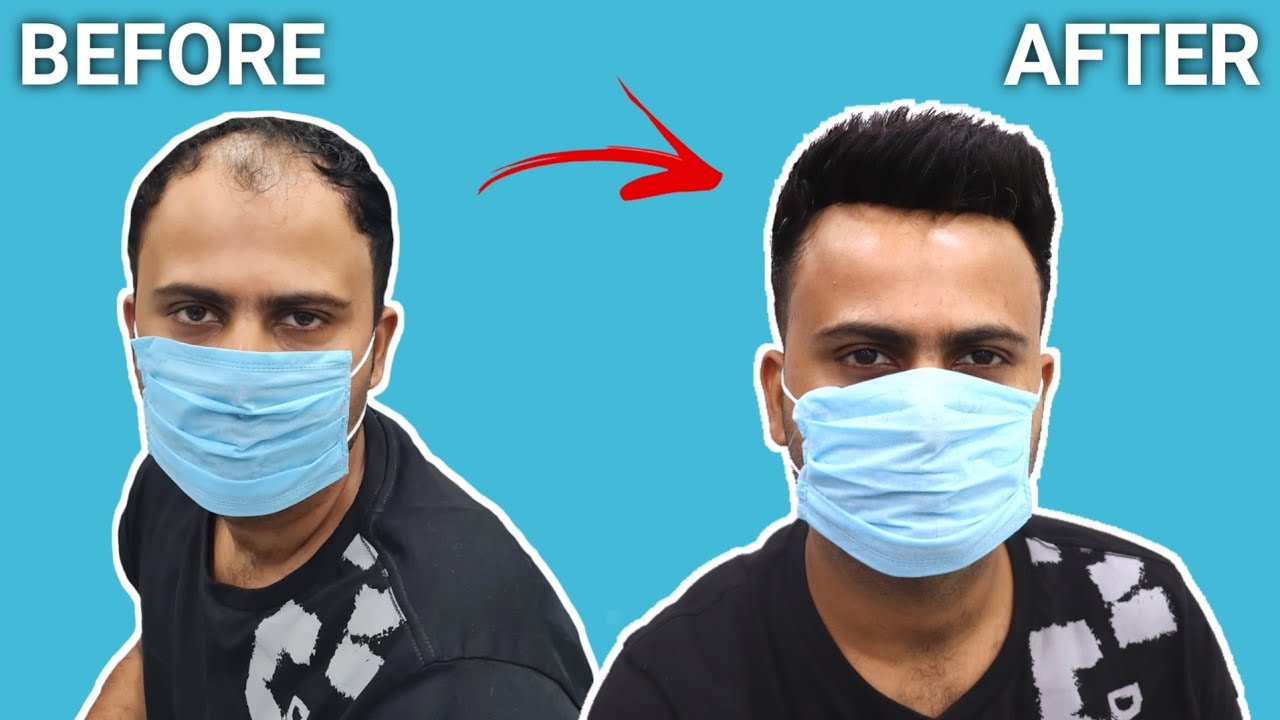 Hair patch for men 2022❤️ | Most natural looking hair patch for men in Delhi