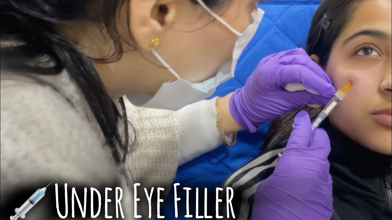 I GOT UNDER EYE FILLER👁️|| BEFORE AND AFTER || THE PROCEDURE || DETAILED VIDEO