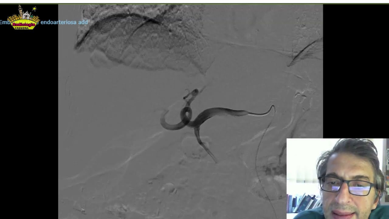 Embolizzazione Arteria Gastroduodenale con Micro Plug MVP-5Q