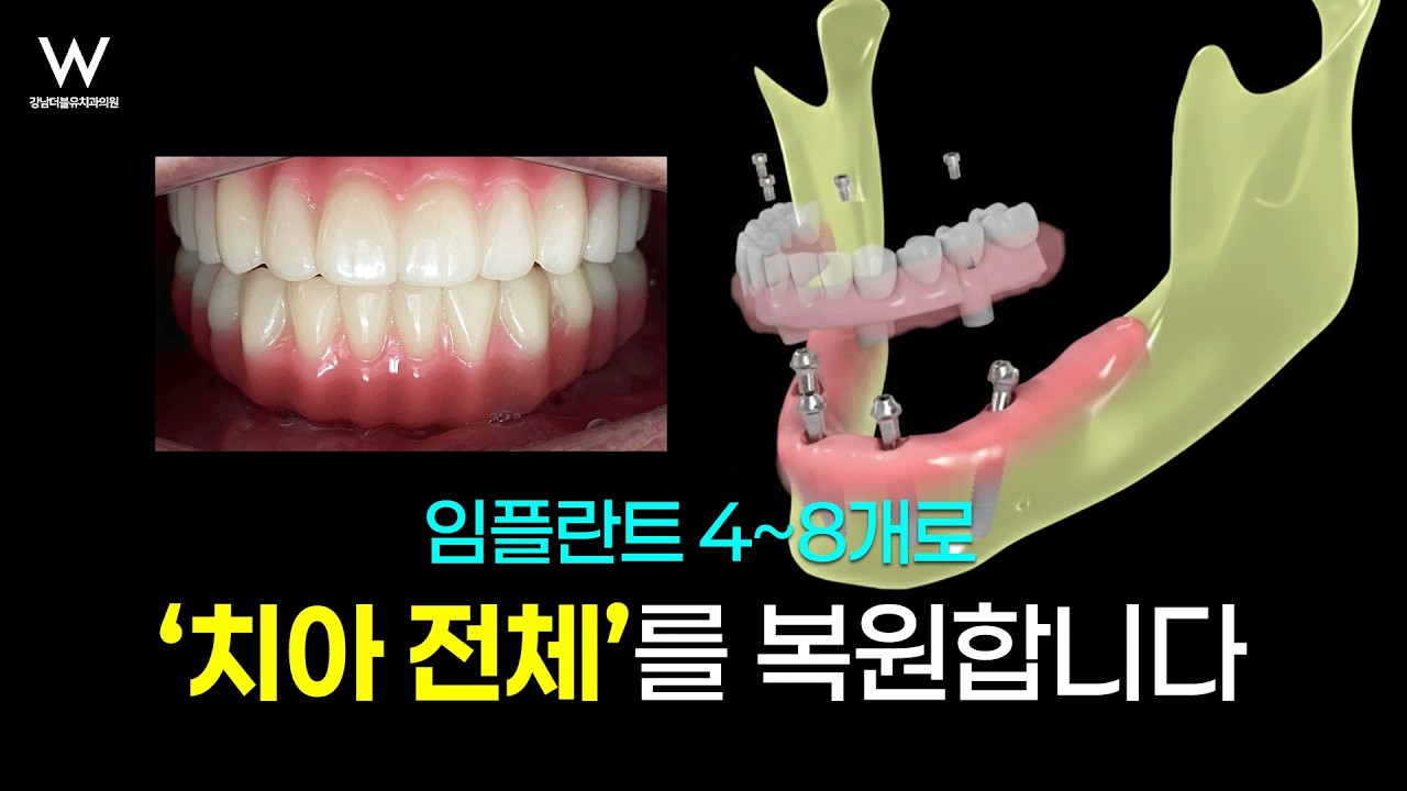 임플란트 4개로 치아 전부 만든다고요? 풀아치임플란트? 올온엑스?