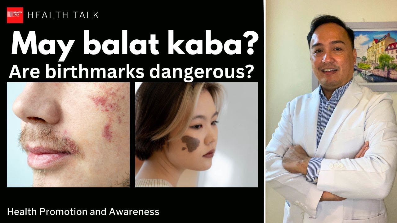 Delikado ba ang mga balat? Are birthmarks dangerous?