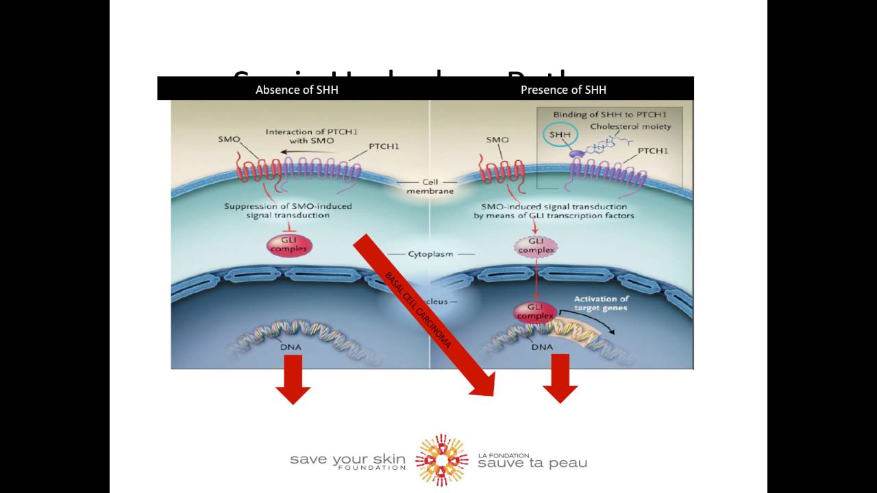 Educational Video Series: What is Basal Cell Carcinoma (BCC)