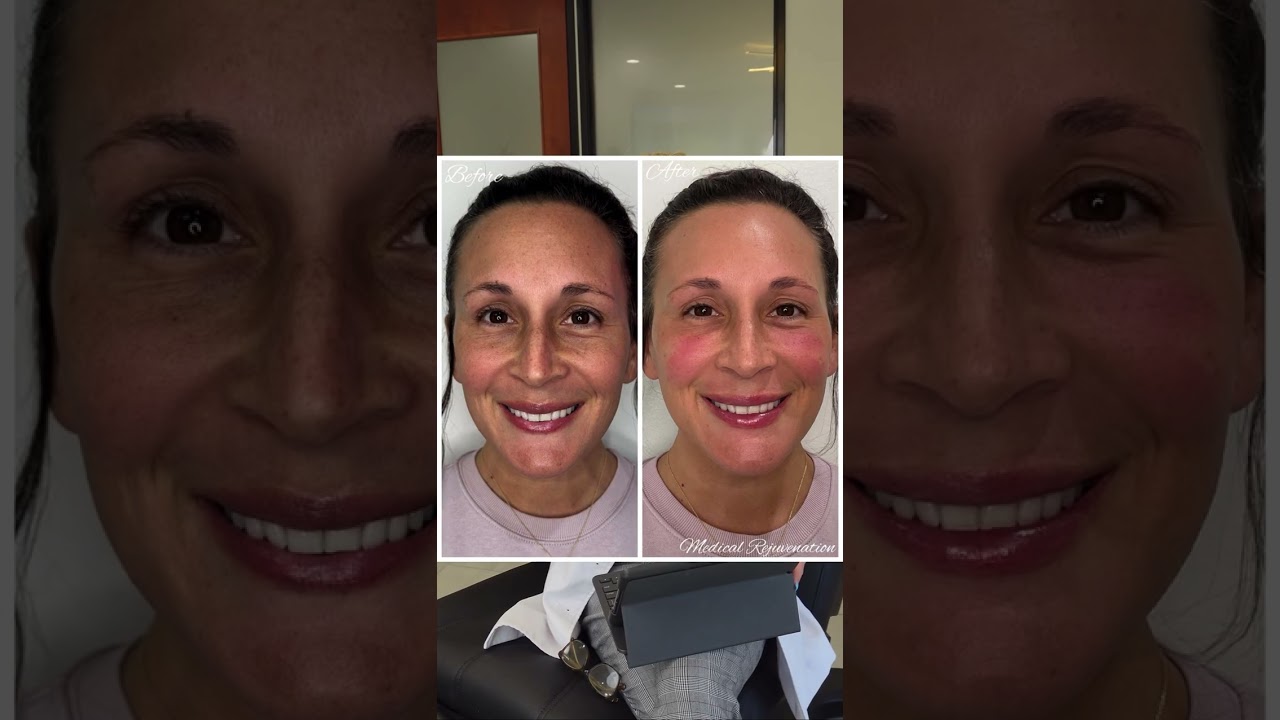 PRF + Tear Trough Filler: Best Fillers, Ratios & Results