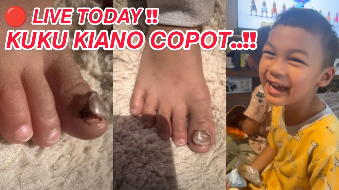 KIANO KUKU KAKI COPOT.. JEMPOL SAMPE BIRU ITEM‼️ PAPAWONG BINGUNG KIANO JAWAB SANTUY 
