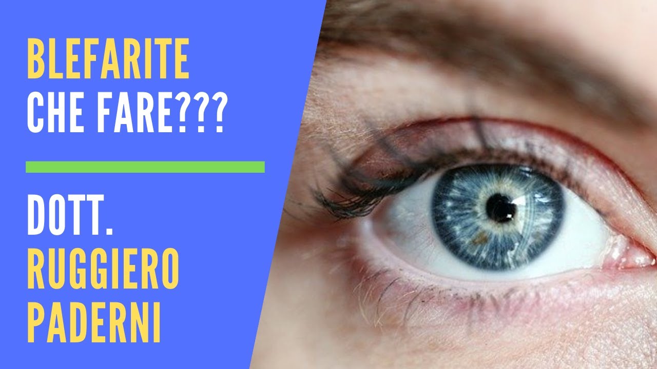 Blefarite: Sintomi, Diagnosi e Cura - Dott. Ruggiero Paderni Oculista