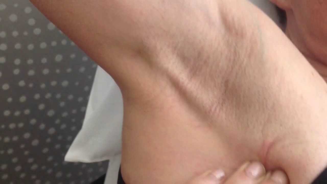 Axillary Cording - Breast Cancer Rehabilitation