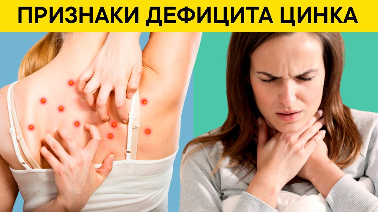 10 Тревожных Признаков Дефицита Цинка. Быстрые способы восполнения нехватки цинка