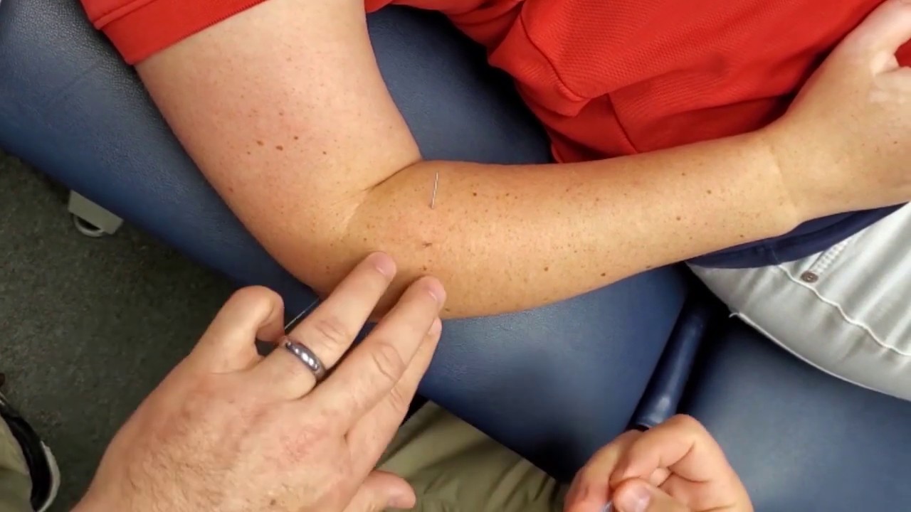 Dry Needling for Tennis and Golfers Elbow