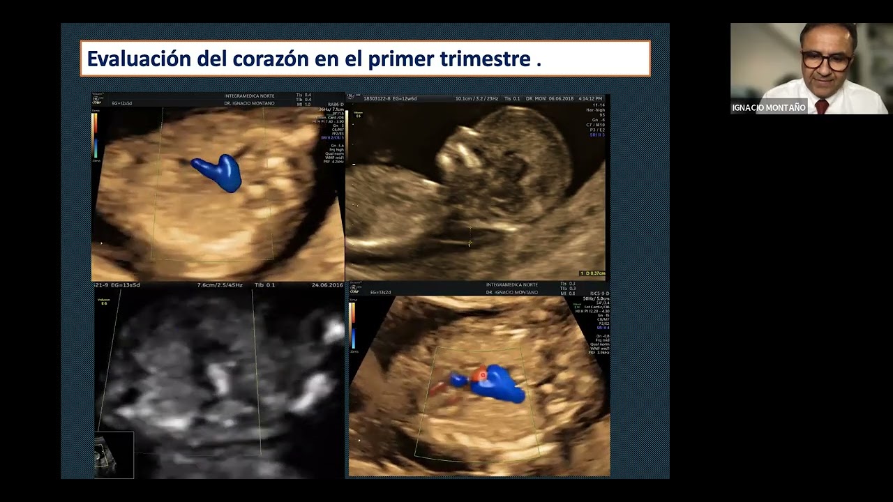 ECOCARDIOGRAFIA FETAL EN EL PRIMER TRIMESTRE DEL EMBARAZO           12 A 16 SEMANAS.