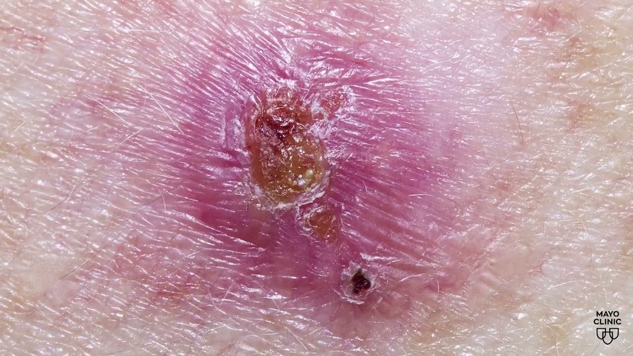 Mayo Clinic Minute - The most common types of skin cancer